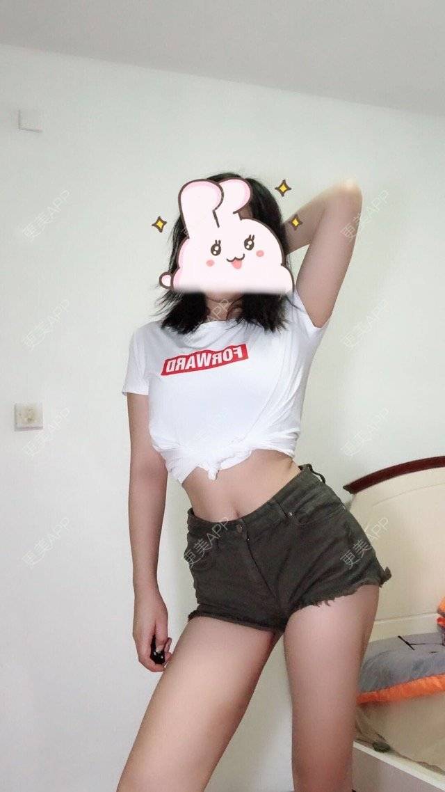 更美 - 更美用户5NSwwHUH8w的自体脂肪丰臀经验 | 成都 | 自体脂肪丰臀