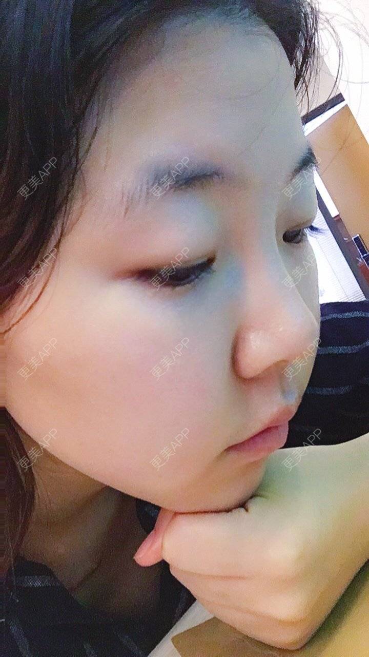 北方丫头的玻尿酸垫下巴日记