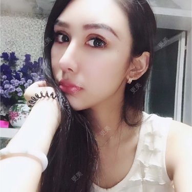 膨体垫眉弓