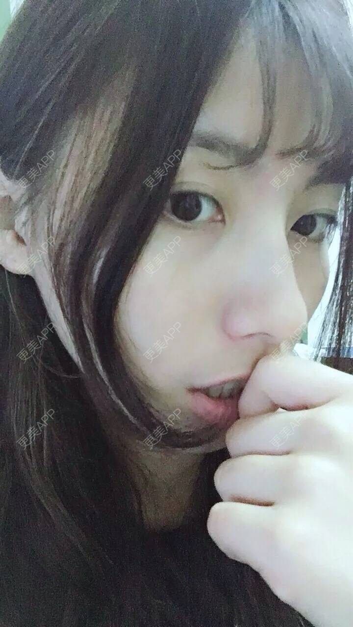 更美 - 范倩茜 医生的全切双眼皮经验 | 全切双眼皮 | 西安