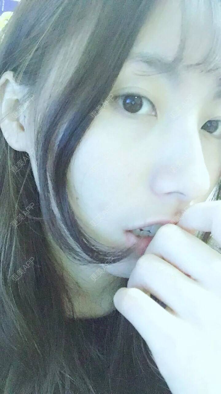 更美 - 范倩茜 医生的全切双眼皮经验 | 全切双眼皮 | 西安