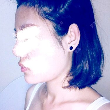 V脸套餐