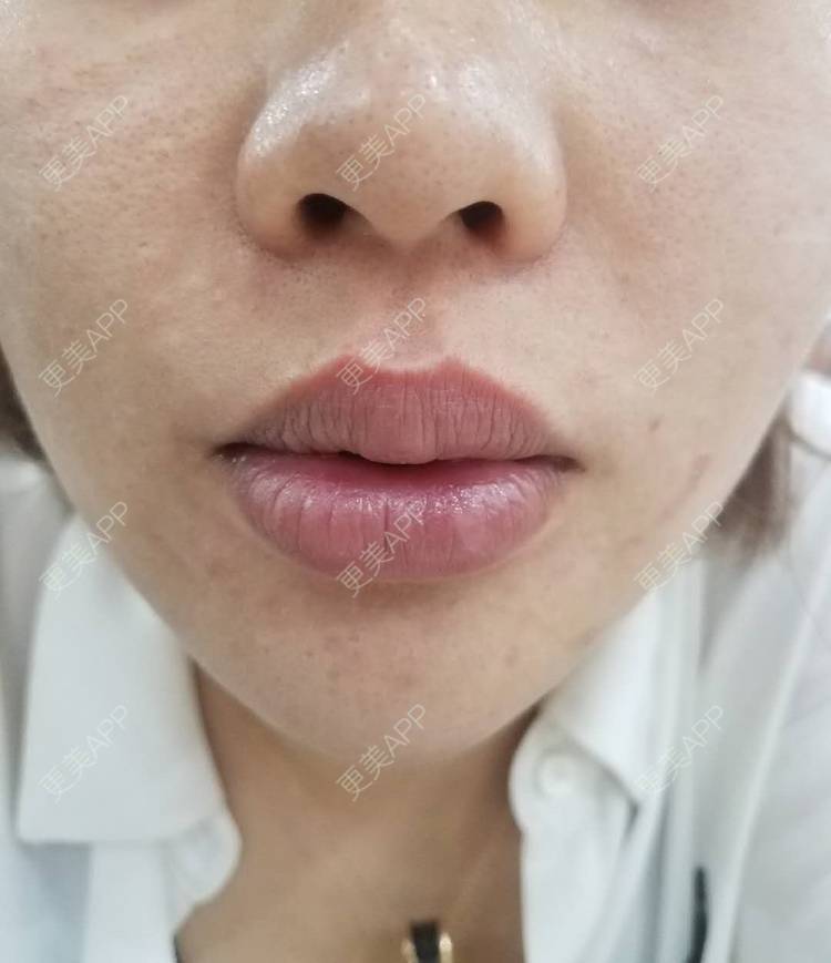 更美 - 戴眼镜的猫咪的玻尿酸唇部经验 | 玻尿酸唇部 | 深圳