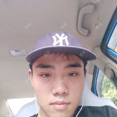 自体脂肪丰面颊