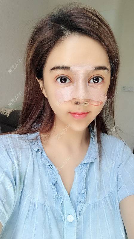 更美 - 小精玲的玻尿酸唇部经验 | 玻尿酸唇部 | 深圳