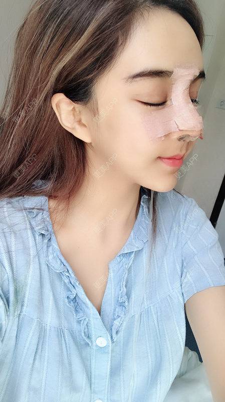 更美 - 小精玲的玻尿酸唇部经验 | 玻尿酸唇部 | 深圳