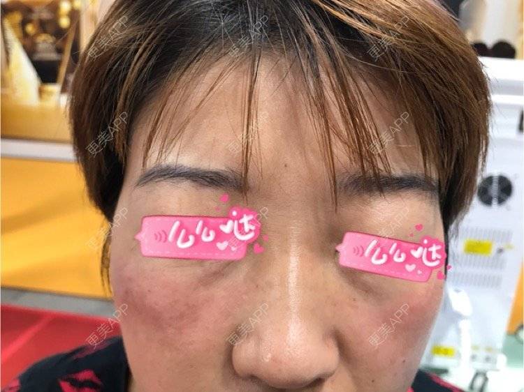 更美 - A奈斯的激光淡斑经验 | 激光淡斑 | 郑州