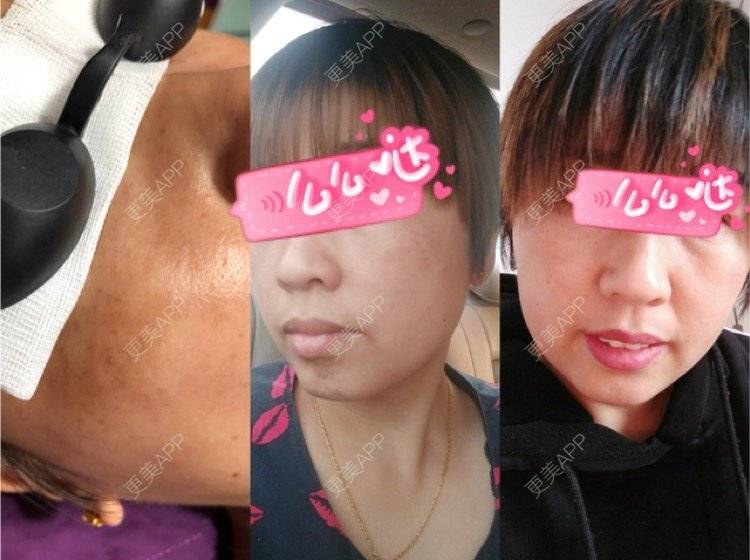 更美 - A奈斯的激光淡斑经验 | 激光淡斑 | 郑州