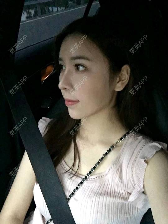 更美 - 小小固执的全切双眼皮经验 | 视频日记 | 全切双眼皮 | 广州