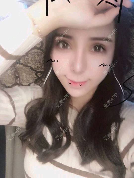 更美 - 小小固执的全切双眼皮经验 | 视频日记 | 全切双眼皮 | 广州