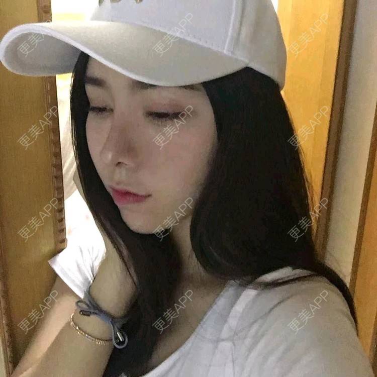 更美 - 小小固执的全切双眼皮经验 | 视频日记 | 全切双眼皮 | 广州