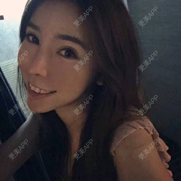更美 - 小小固执的全切双眼皮经验 | 视频日记 | 全切双眼皮 | 广州