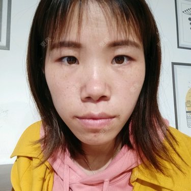 微针淡化妊娠纹