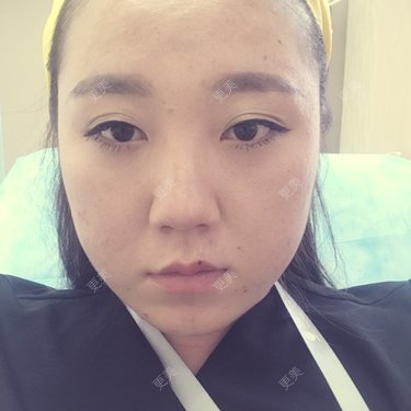 注射溶脂瘦脸