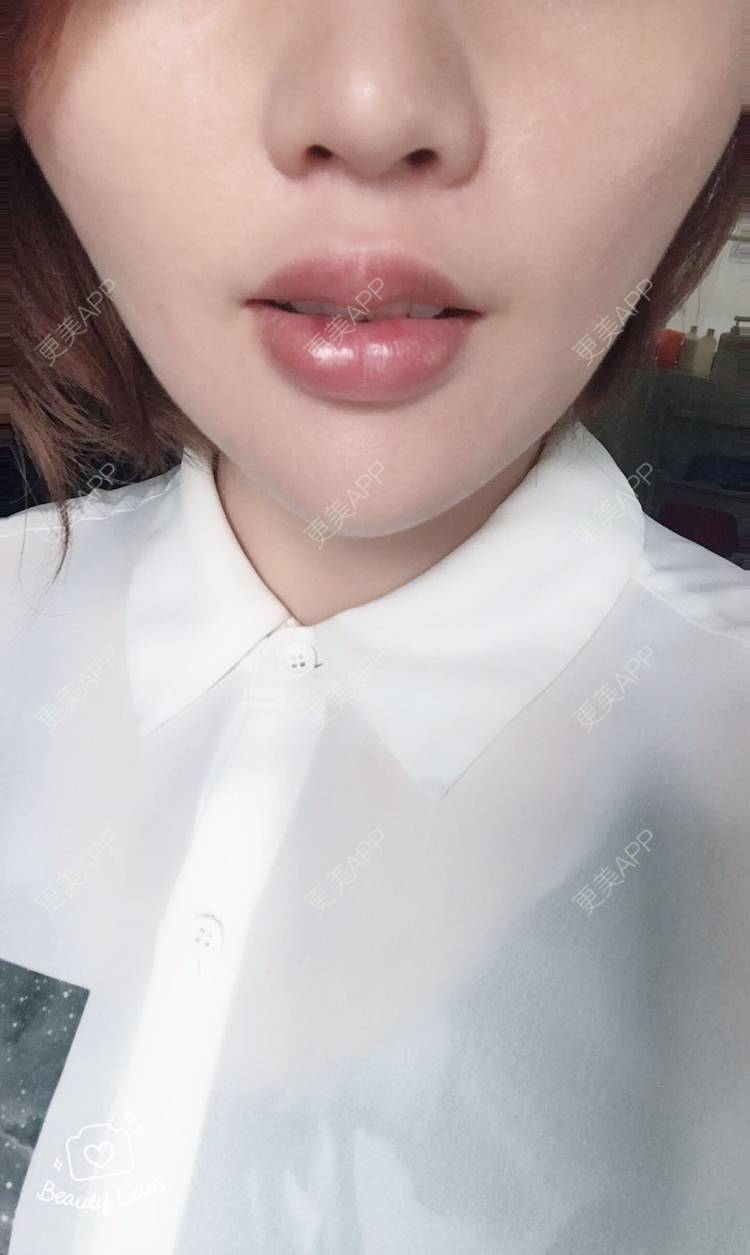 更美 - 戴眼镜的猫咪的玻尿酸唇部经验 | 玻尿酸唇部 | 深圳