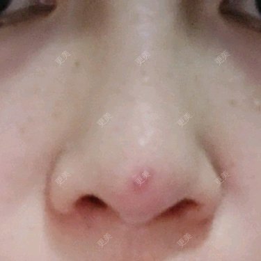 埋线隆鼻