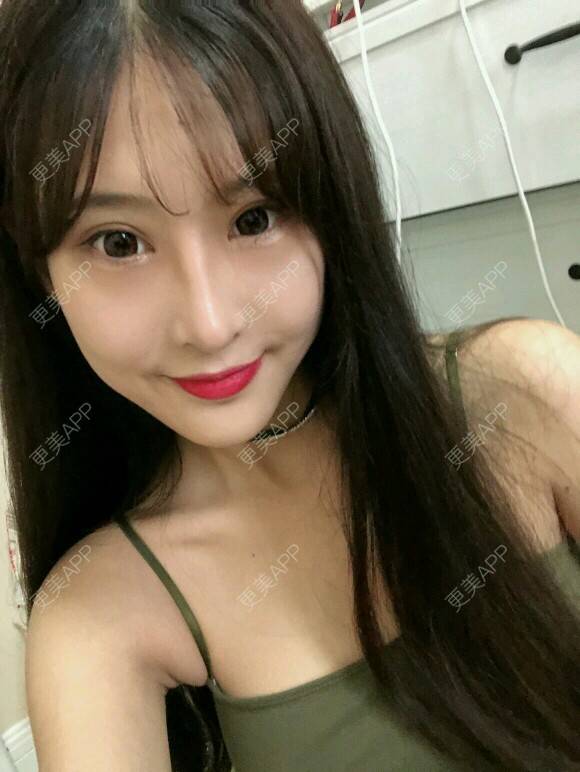 更美 - 酷帅北鼻妞儿的胶原蛋白丰太阳穴经验 | 北京 | 胶原蛋白丰太阳穴