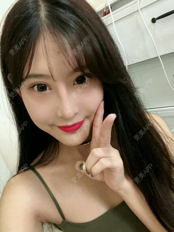 更美 - 酷帅北鼻妞儿的胶原蛋白丰太阳穴经验 | 北京 | 胶原蛋白丰太阳穴