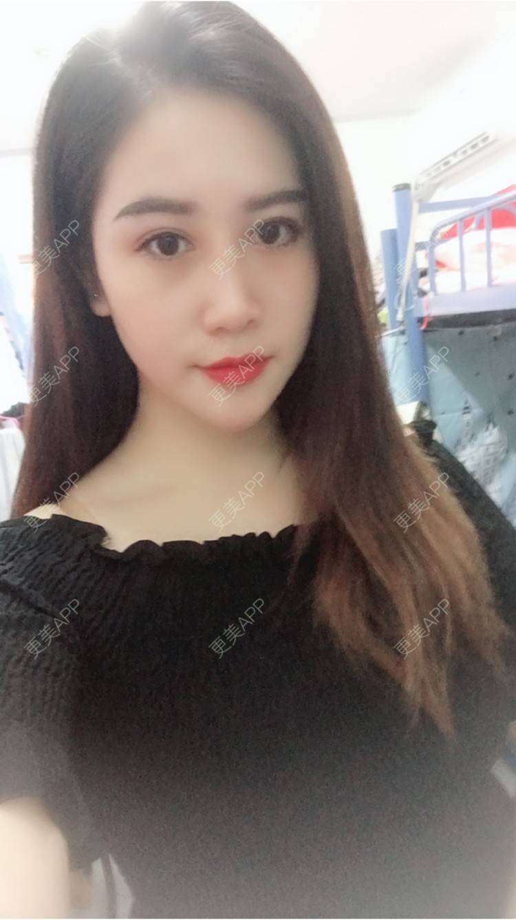 更美 - 更美用户50063163的玻尿酸经验 | 上海 | 假体隆胸 | 隆鼻 | 广州 | 埋线提升 | 北京 | 玻尿酸