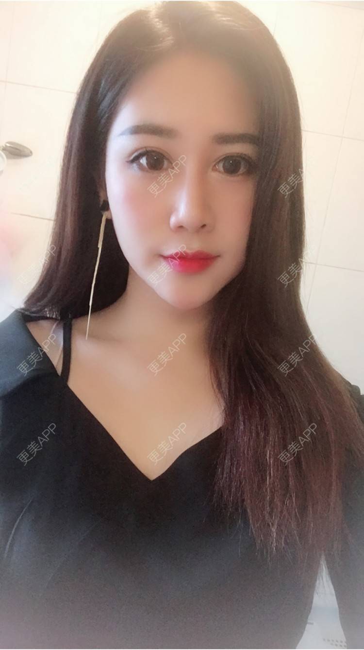 更美 - 更美用户50063163的玻尿酸经验 | 上海 | 假体隆胸 | 隆鼻 | 广州 | 埋线提升 | 北京 | 玻尿酸