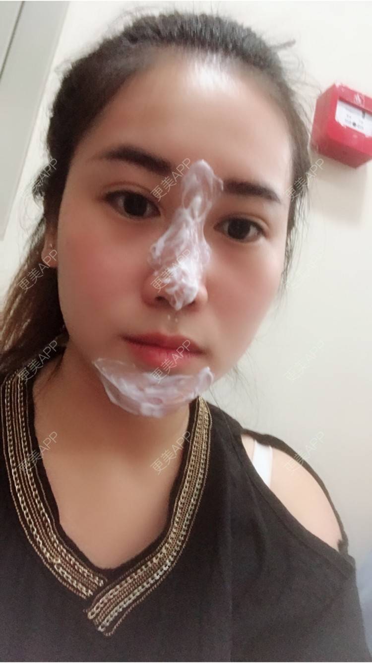 更美 - 更美用户50063163的玻尿酸经验 | 上海 | 假体隆胸 | 隆鼻 | 广州 | 埋线提升 | 北京 | 玻尿酸