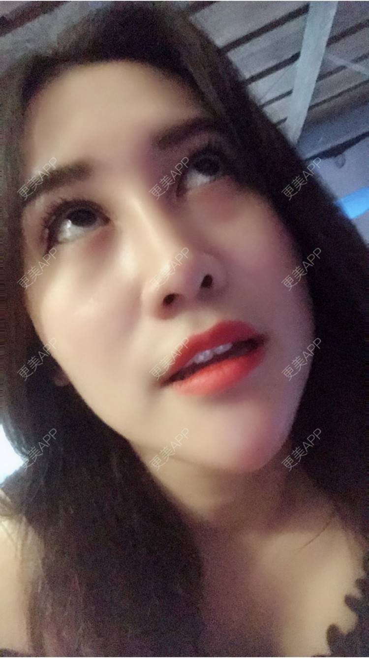 更美 - 更美用户50063163的玻尿酸经验 | 上海 | 假体隆胸 | 隆鼻 | 广州 | 埋线提升 | 北京 | 玻尿酸