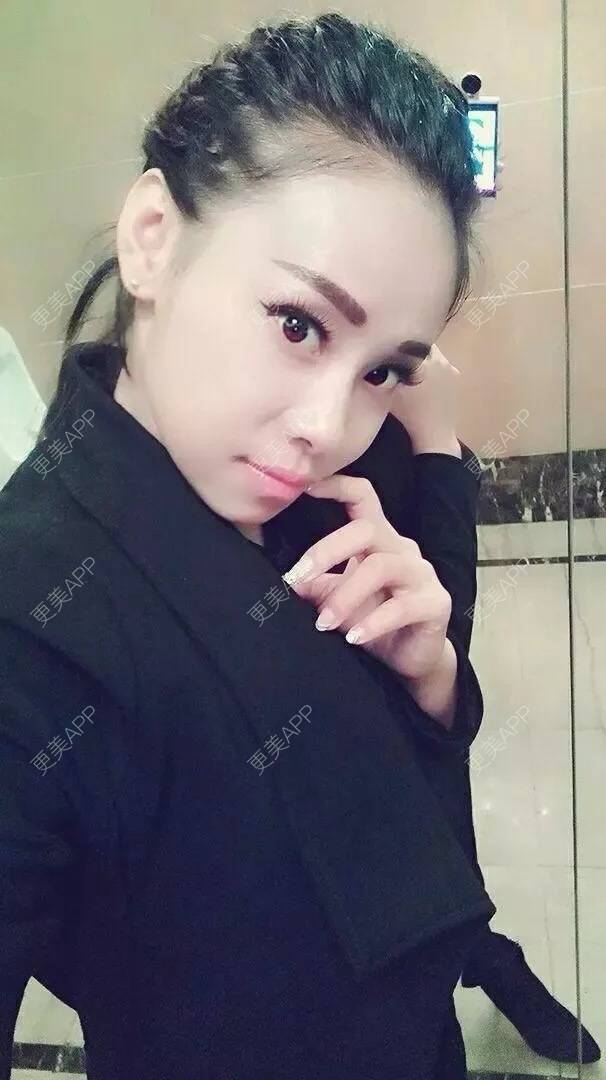 更美 - 采星星的小太阳的自体脂肪隆鼻经验 | 西安 | 自体脂肪隆鼻