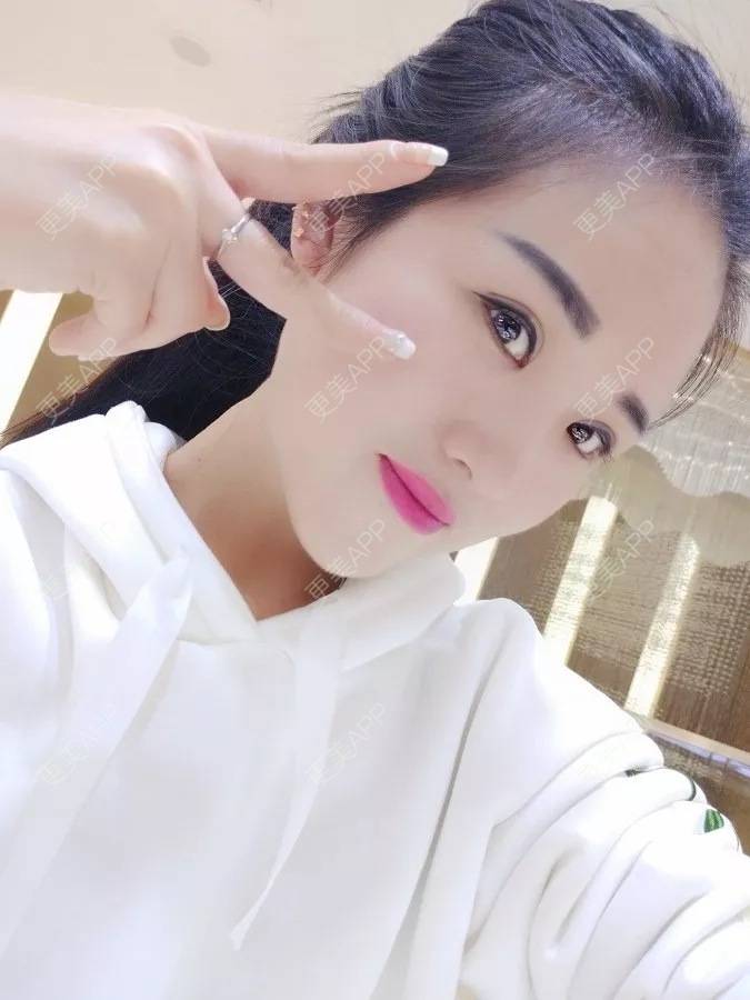 更美 - 再以永恒为基的自体脂肪隆鼻经验 | 西安 | 自体脂肪隆鼻