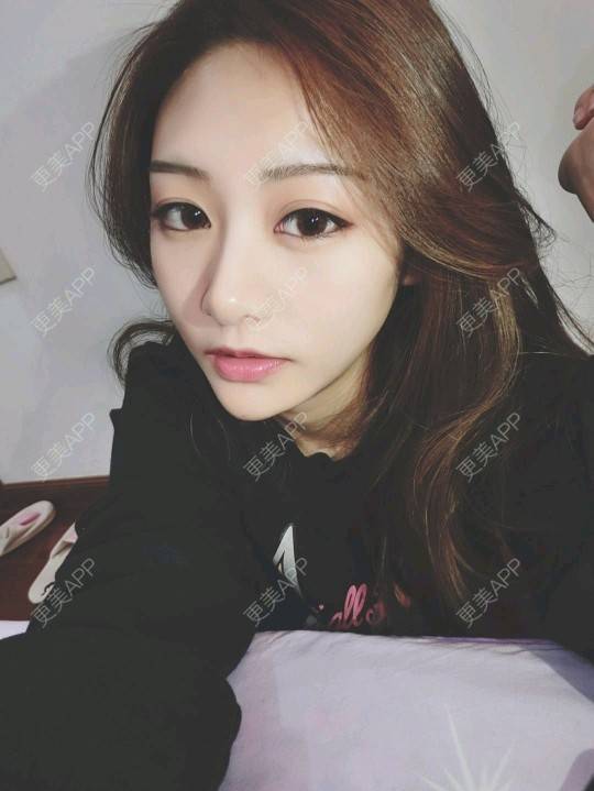 m无处安放的女人的玻尿酸下巴日记