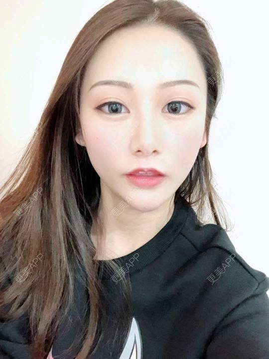 m无处安放的女人的玻尿酸下巴日记