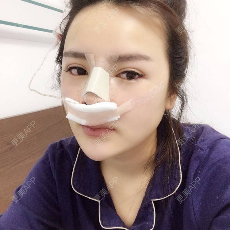 更美 - 更美用户wSuQNG6YOw的鼻中隔软骨隆鼻经验 | 西安 | 鼻中隔软骨隆鼻