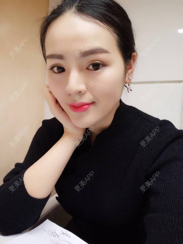 更美 - 更美用户wSuQNG6YOw的鼻中隔软骨隆鼻经验 | 西安 | 鼻中隔软骨隆鼻