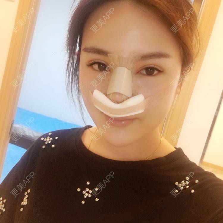 更美 - 更美用户wSuQNG6YOw的鼻中隔软骨隆鼻经验 | 西安 | 鼻中隔软骨隆鼻