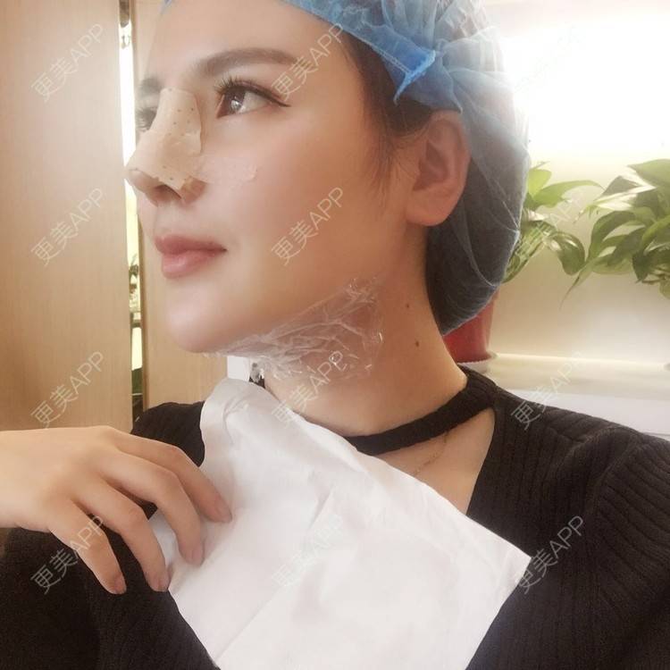 更美 - 更美用户wSuQNG6YOw的鼻中隔软骨隆鼻经验 | 西安 | 鼻中隔软骨隆鼻