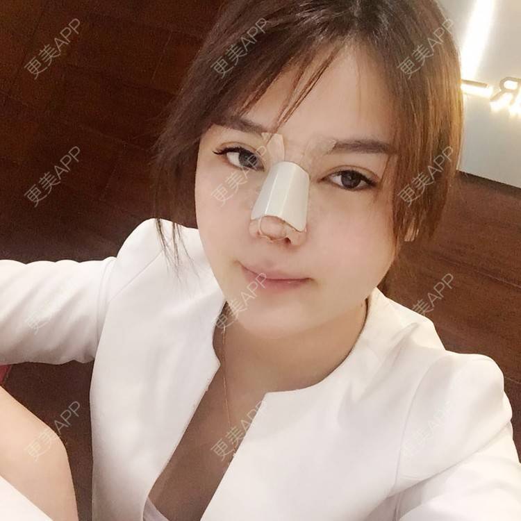 更美 - 更美用户wSuQNG6YOw的鼻中隔软骨隆鼻经验 | 西安 | 鼻中隔软骨隆鼻