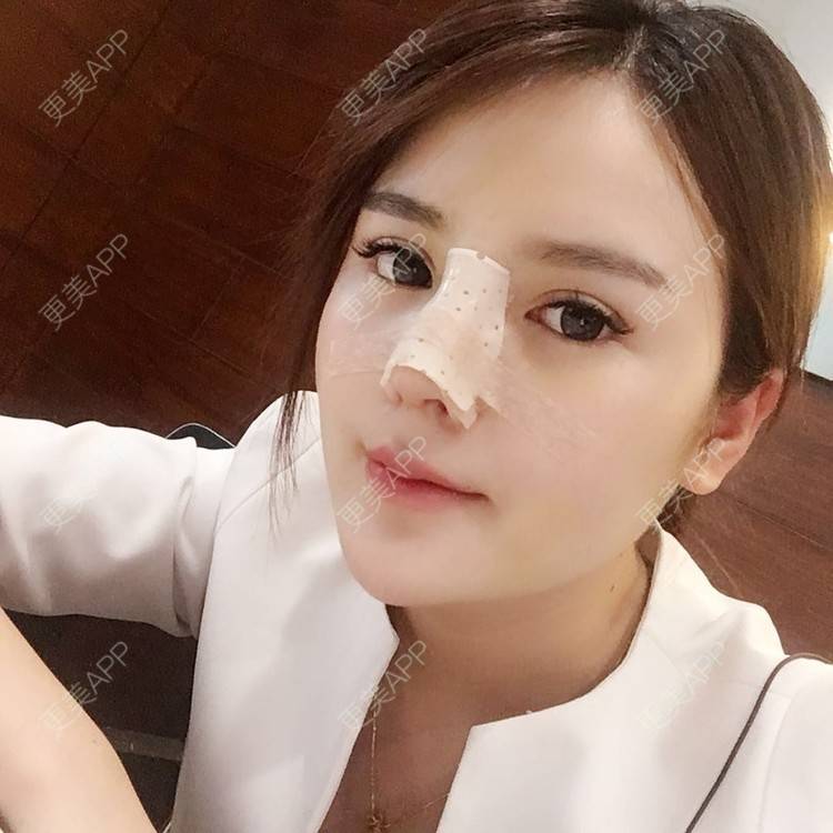 更美 - 更美用户wSuQNG6YOw的鼻中隔软骨隆鼻经验 | 西安 | 鼻中隔软骨隆鼻