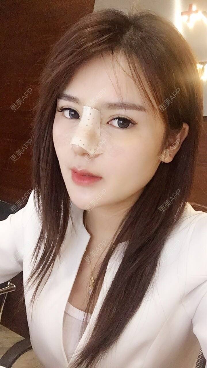 更美 - 更美用户wSuQNG6YOw的鼻中隔软骨隆鼻经验 | 西安 | 鼻中隔软骨隆鼻