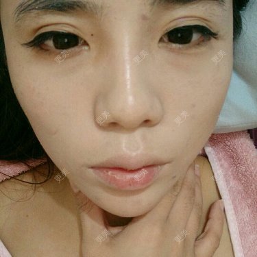 玻尿酸溶解酶