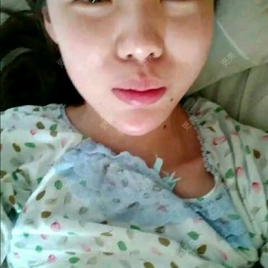 玻尿酸溶解酶