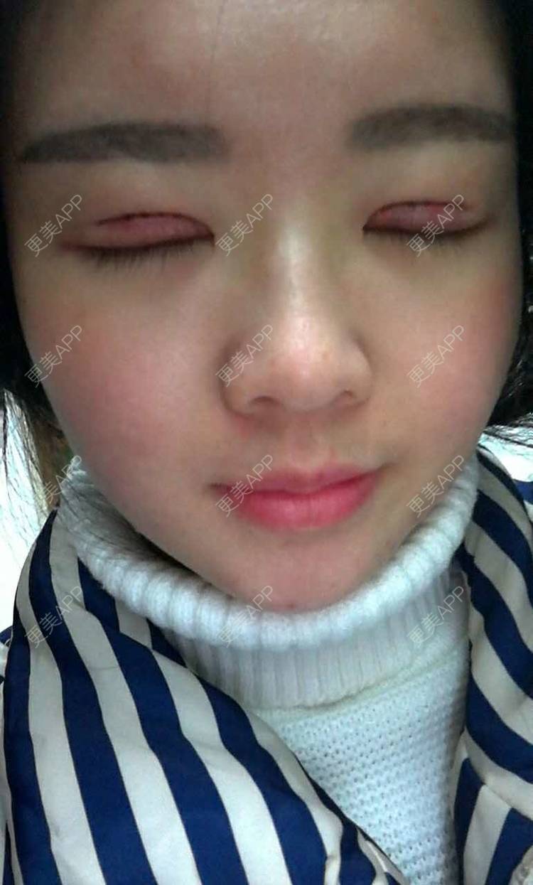 咿呀呀的全切双眼皮日记