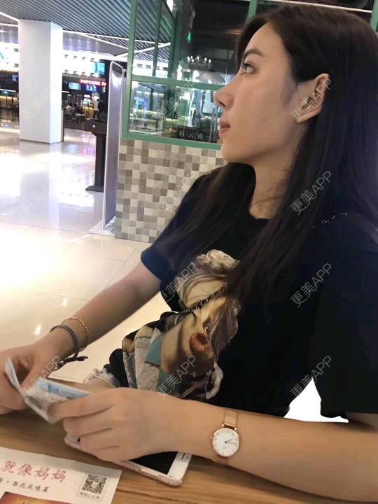 更美 - 小小固执的全切双眼皮经验 | 视频日记 | 全切双眼皮 | 广州