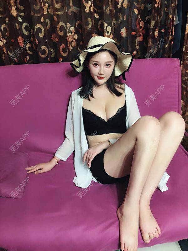 更美 - 棉花糖一朵朵的自体脂肪隆胸经验 | 丰胸（隆胸） | 重庆 | 自体脂肪隆胸