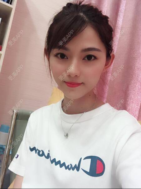 更美 - 更美用户5DzMfqbMYN的玻尿酸苹果肌经验 | 长沙 | 玻尿酸苹果肌