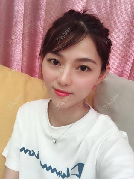 更美 - 更美用户5DzMfqbMYN的玻尿酸苹果肌经验 | 长沙 | 玻尿酸苹果肌