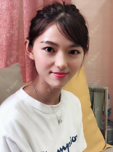 更美 - 更美用户5DzMfqbMYN的玻尿酸苹果肌经验 | 长沙 | 玻尿酸苹果肌