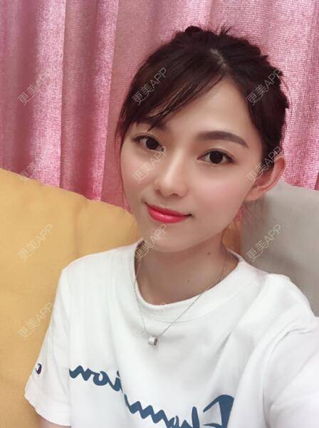 更美 - 更美用户5DzMfqbMYN的玻尿酸苹果肌经验 | 长沙 | 玻尿酸苹果肌