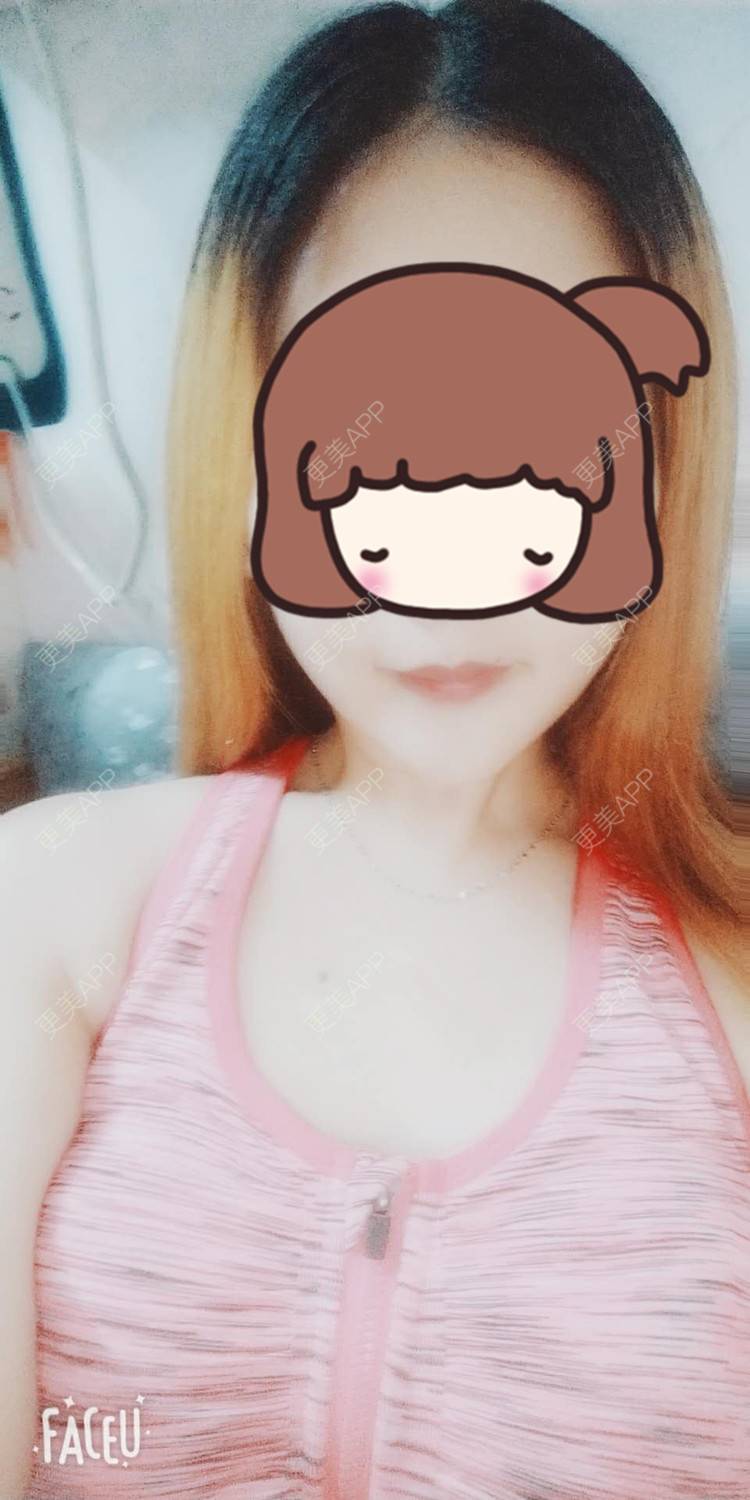 更美 - 更美用户acxfenjjw1的假体隆胸日记 | 广州 | 丰胸(隆胸)