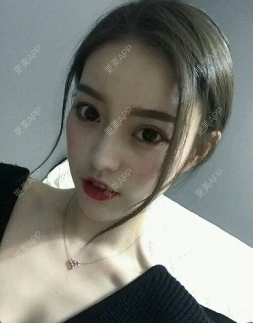 更美 - 秘夜魄的冷光美白经验 | 成都 | 冷光美白