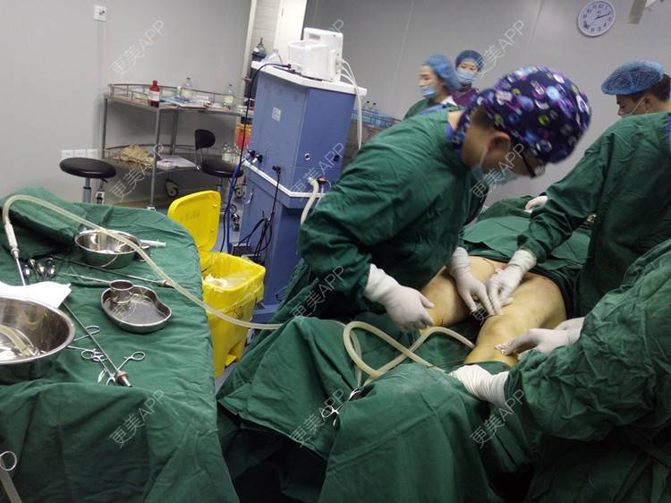 吸脂瘦大腿手术_最好的自己11吸脂瘦大腿手术_术后3天__更美整形