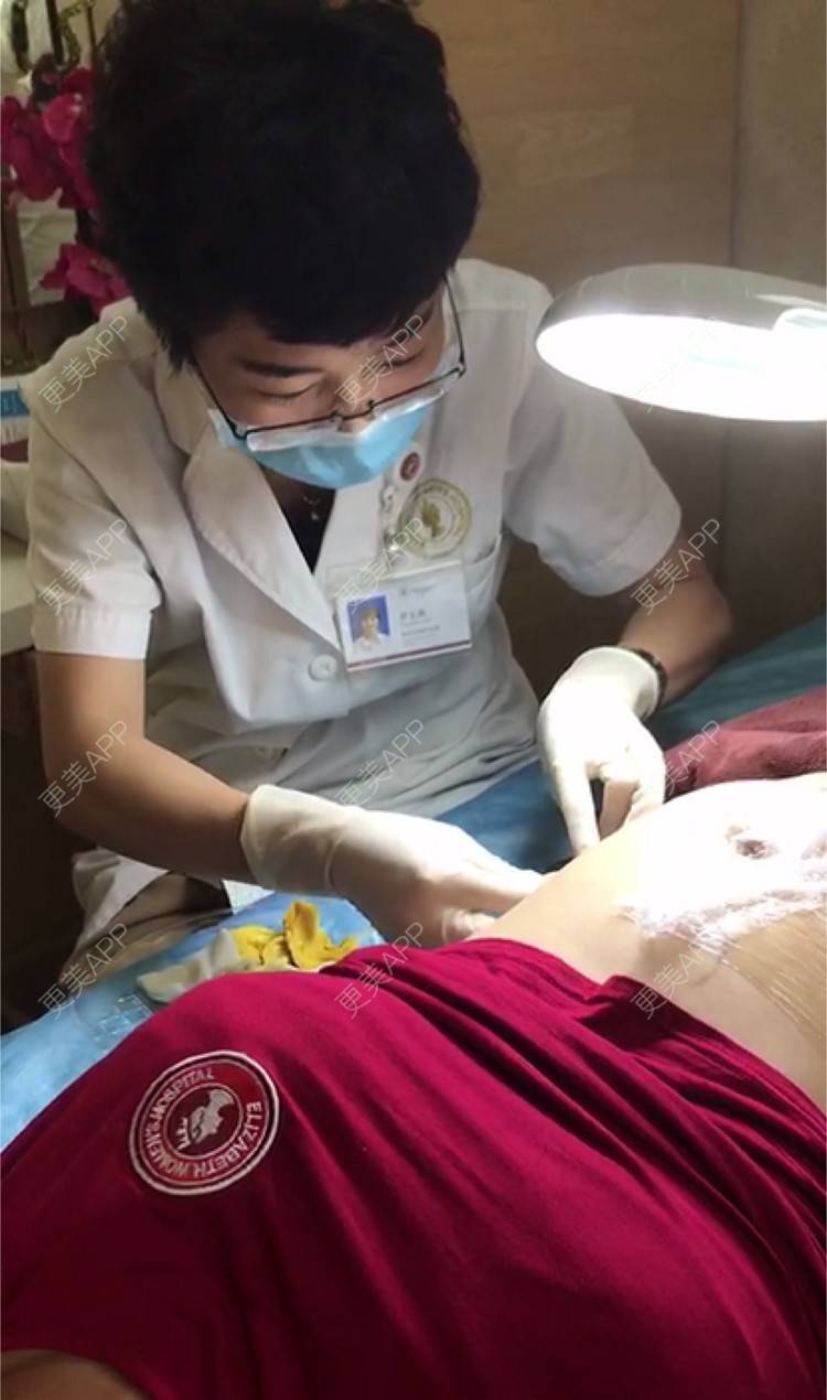 更美 - 思念是病o的激光淡化妊娠纹经验 | 广州 | 视频日记 | 激光淡化妊娠纹